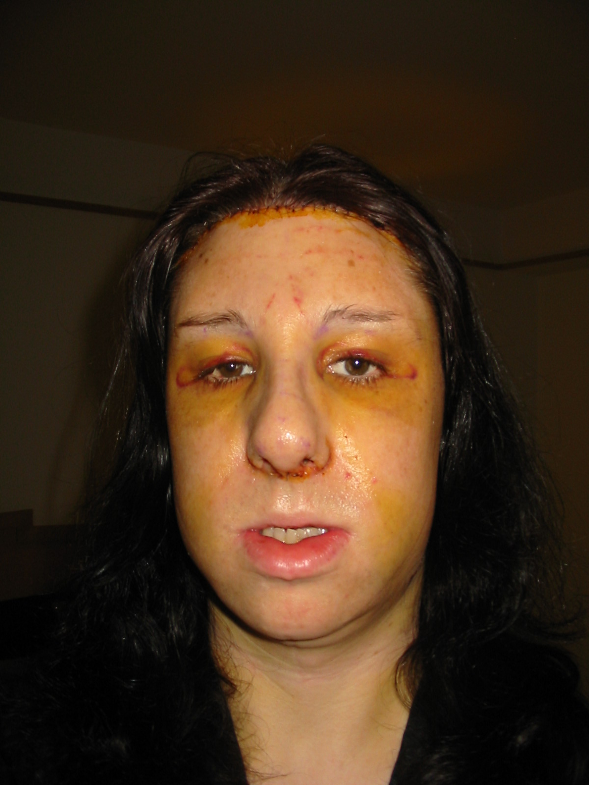 My face at 4 days post op. Although I was bruised and badly swollen, the effects of the brow lift and chin reduction are striking